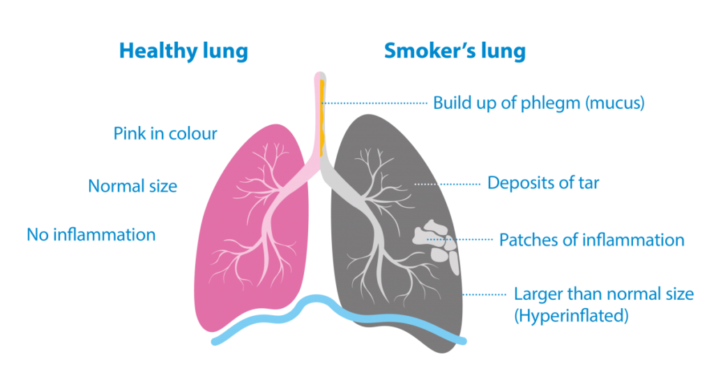 How Does Smoking Affect My Health?