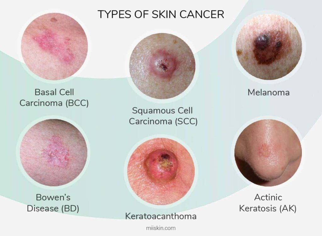 What Are The Early Signs Of Skin Cancer?
