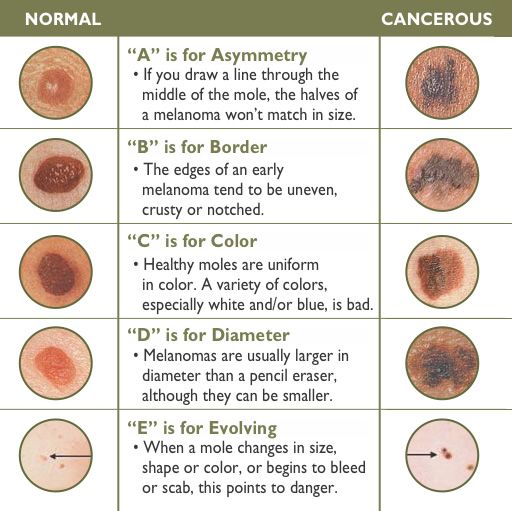 What Are The Early Signs Of Skin Cancer?